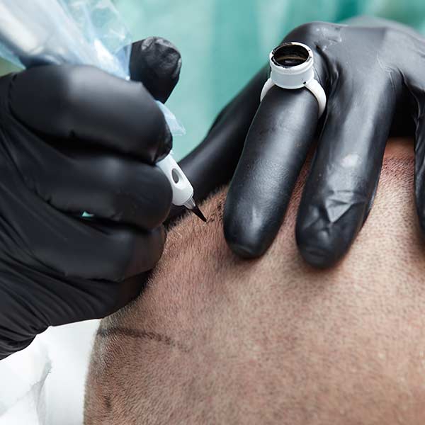 Micropigmentación Capilar y Microblading en Madrid Micropigmentación Capilar y Microblading en Madrid