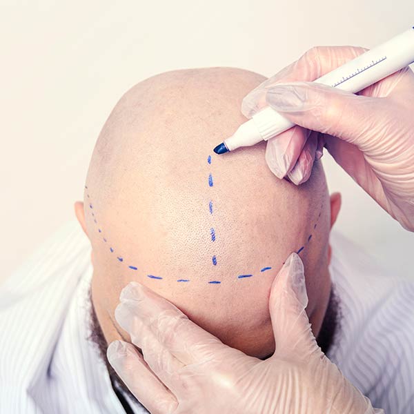 Micropigmentación Capilar y Microblading en Madrid Micropigmentación Capilar y Microblading en Madrid