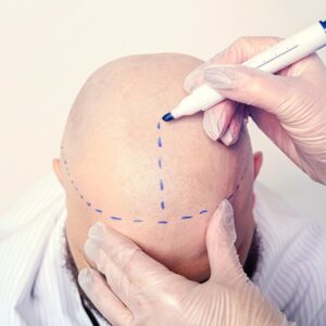 Diagnóstico de Micropigmentación Capilar en Madrid